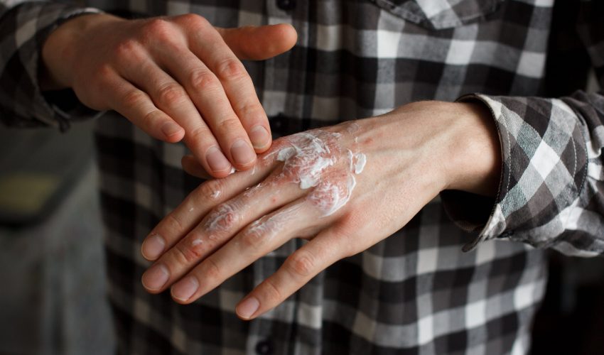 Psoriasis Awareness Month: How Can YOU Give Back?
