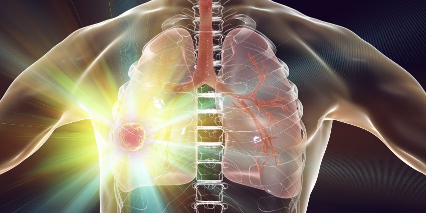 Diagnosing and Treating Lung Cancer